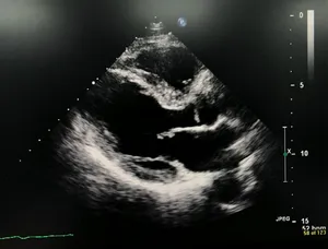 ecocardiography.png